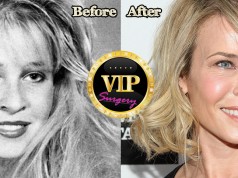 Chelsea Handler plastic surgery