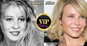 Chelsea Handler plastic surgery
