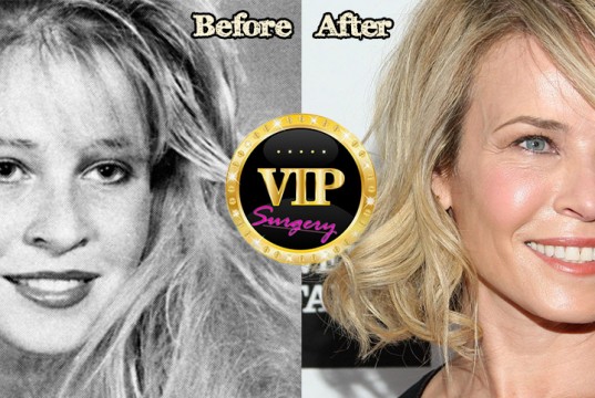 Chelsea Handler plastic surgery