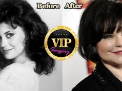 Delta Burke before and after plastic surgery