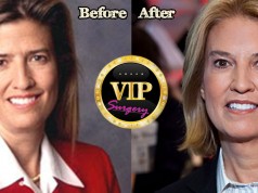 Greta Van Susteren plastic surgery