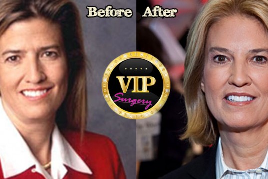 Greta Van Susteren plastic surgery