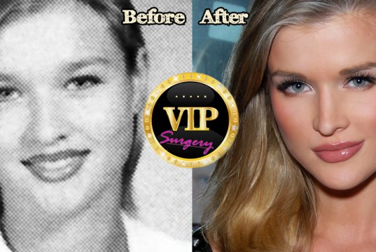 Joanna Krupa plastic surgery