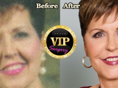 Joyce Meyers plastic surgery