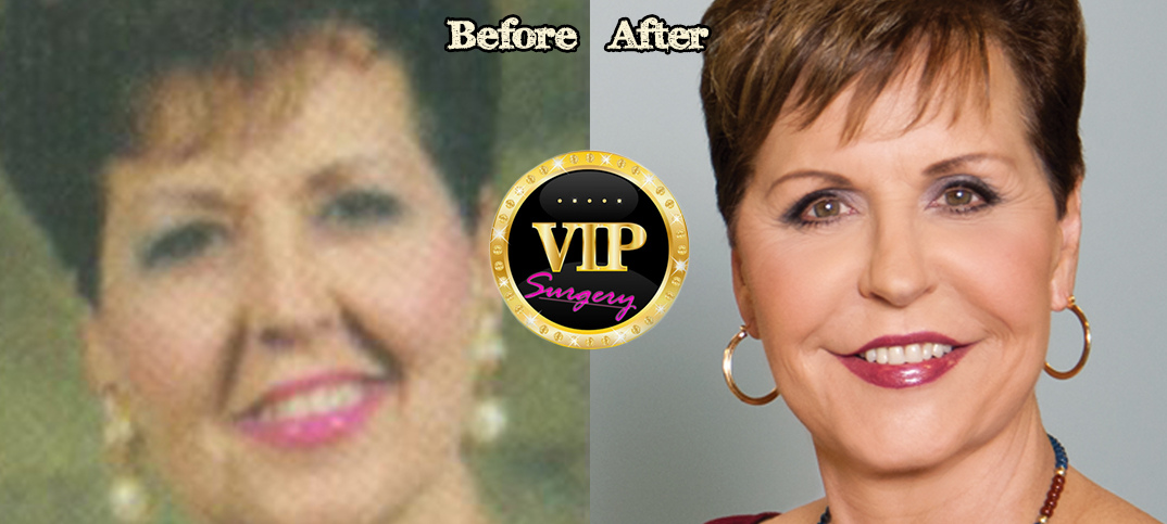 Joyce Meyers plastic surgery speculations, Before and After Photos and the ...