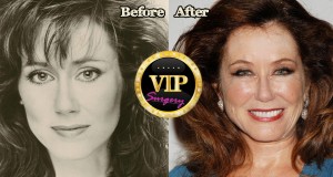 Mary Mcdonnell plastic surgery