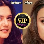 Preity Zinta plastic surgery