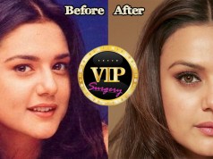 Preity Zinta plastic surgery