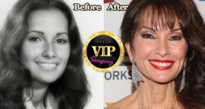 Susan Lucci plastic surgery