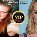 Taylor Armstrong plastic surgery