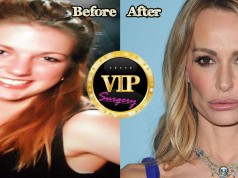 Taylor Armstrong plastic surgery