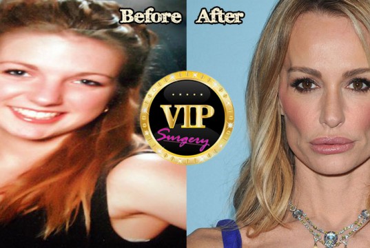 Taylor Armstrong plastic surgery