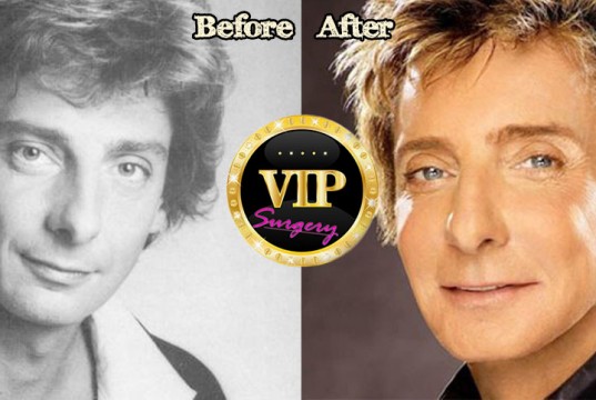 barry manilow plastic surgery