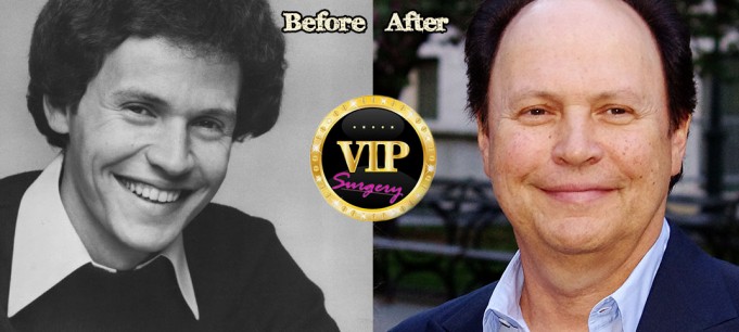 billy crystal plastic surgery