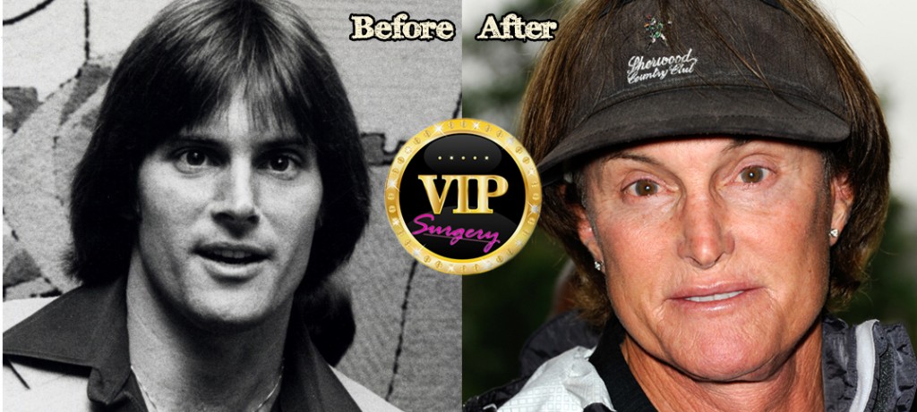 Bruce Jenner Plastic Surgery Before And After Photos