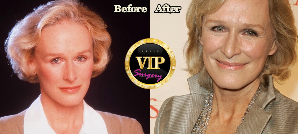 glenn close plastic surgery Image 8