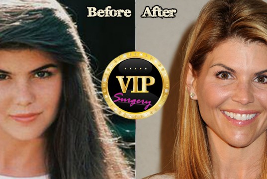 lori loughlin plastic surgery