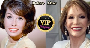 mary tyler moore plastic surgery