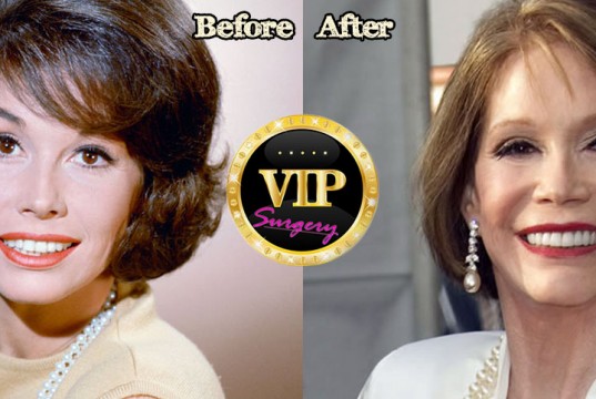 mary tyler moore plastic surgery