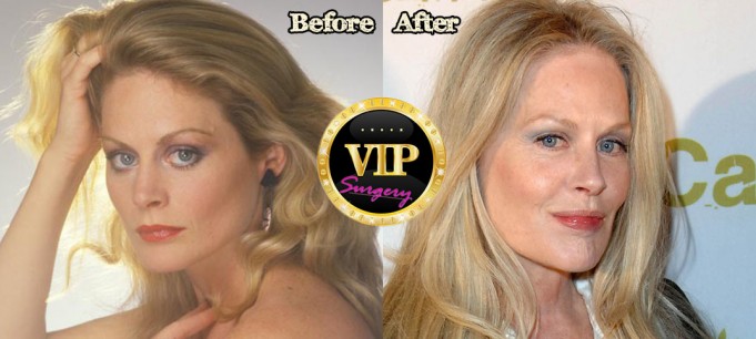 Beverly D Angelo Plastic Surgery