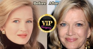 Diane Sawyer plastic surgery