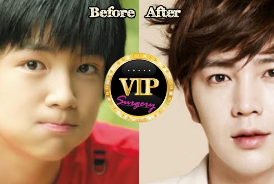 Jang Geun Suk plastic surgery