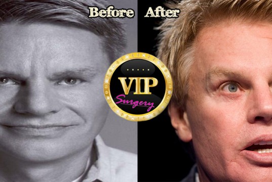 Mike Jeffries plastic surgery