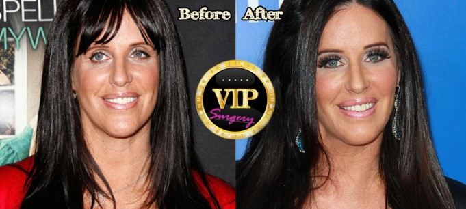 Patti Stanger Plastic Surgery