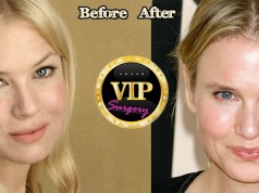 Renee Zellweger plastic surgery