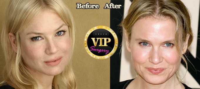 Renee Zellweger plastic surgery