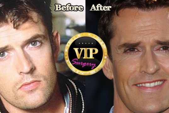 Rupert Everett plastic surgery