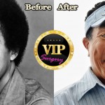Smokey Robinson before and after Plastic Surgery