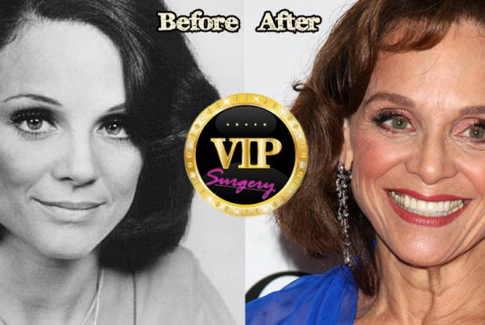 Valerie Harper Plastic Surgery