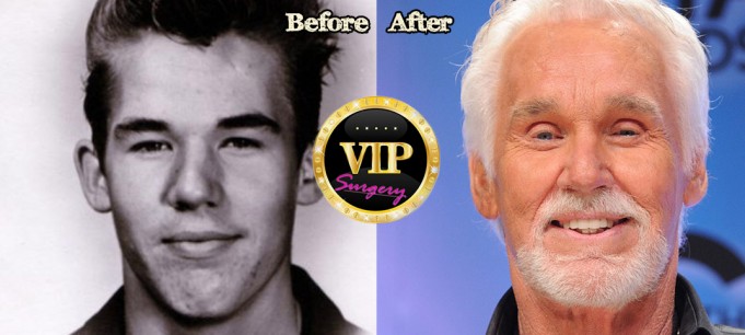 kenny rogers plastic surgery