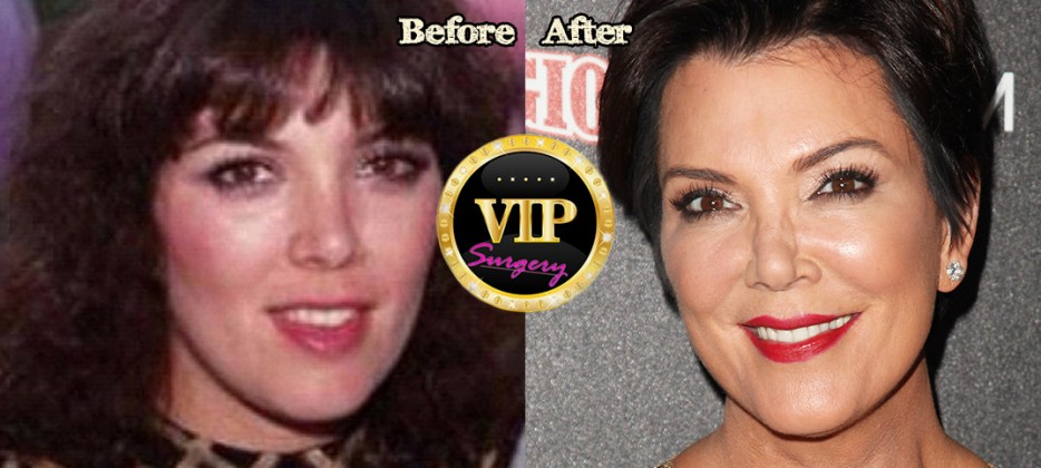 Kris Jenner Plastic Surgery Before And After Photos