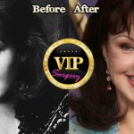 naomi judd before and after plastic surgery
