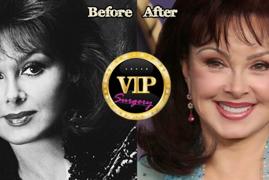 naomi judd before and after plastic surgery