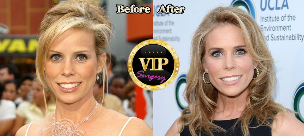 Cheryl Hines Plastic Surgery - With Before And After Photos 615