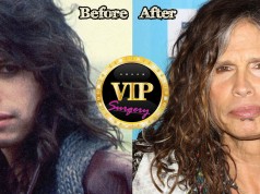 steven tyler plastic surgery