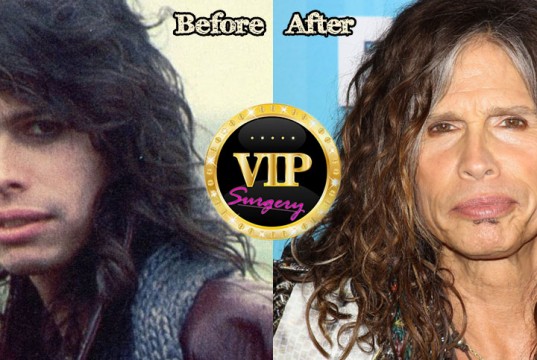 steven tyler plastic surgery