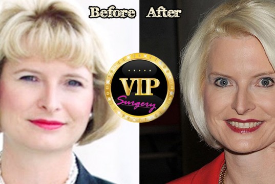 Callista Gingrich Plastic Surgery