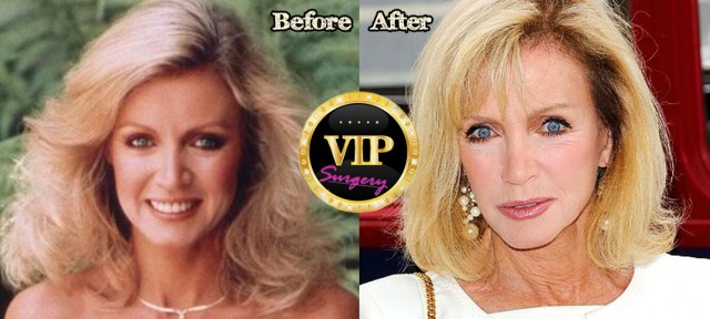 Donna Mills Plastic Surgery Before and After Pictures