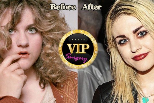 Frances Bean Cobain Plastic Surgery