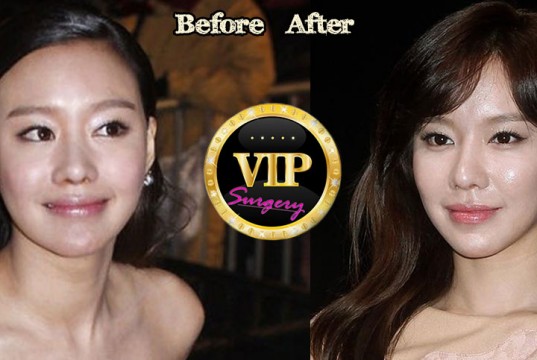 Kim Ah-Joong Plastic Surgery