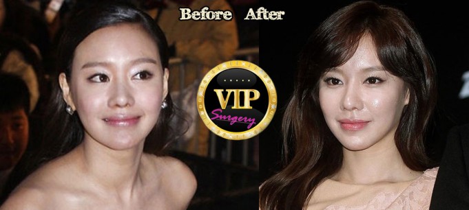 Kim Ah-Joong Plastic Surgery