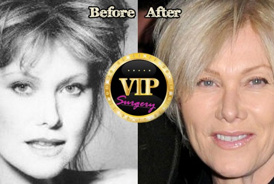 Deborra-lee Furness Plastic Surgery