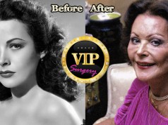 Hedy Lamarr Plastic Surgery