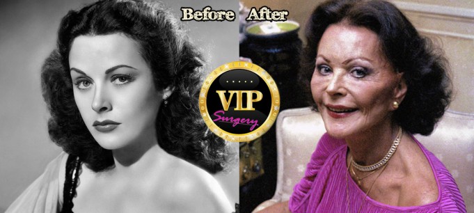 Hedy Lamarr Plastic Surgery