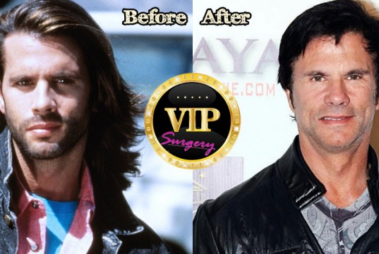 Lorenzo Lamas Plastic Surgery