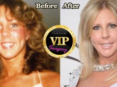 Vicki Gunvalson Plastic Surgery